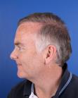 After Hair Transplant&nbsp;2 Sessions (Areas)